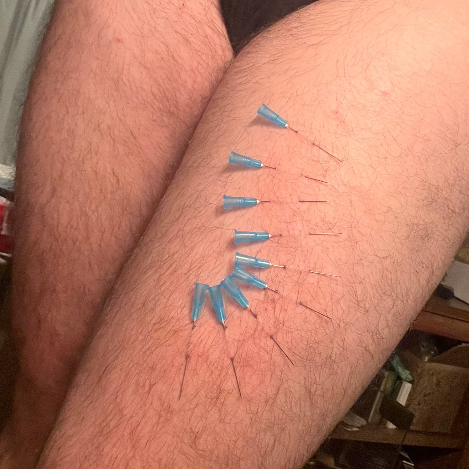 A hairy, white thigh is pierced with nine needles in a flowing pattern down the leg.